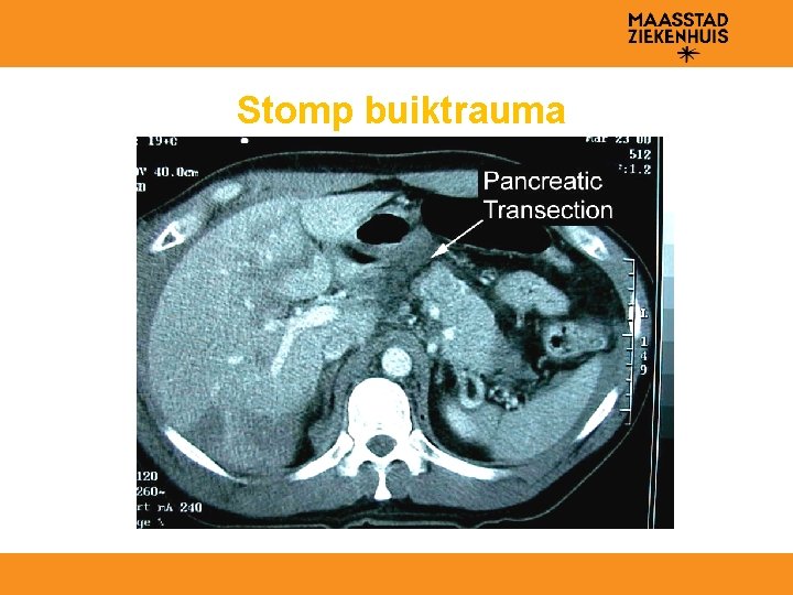Stomp buiktrauma 