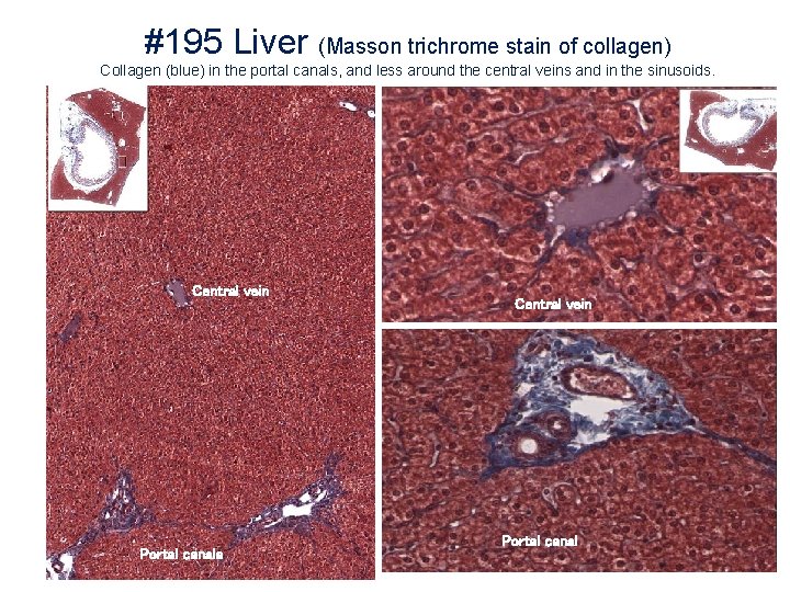 #195 Liver (Masson trichrome stain of collagen) Collagen (blue) in the portal canals, and