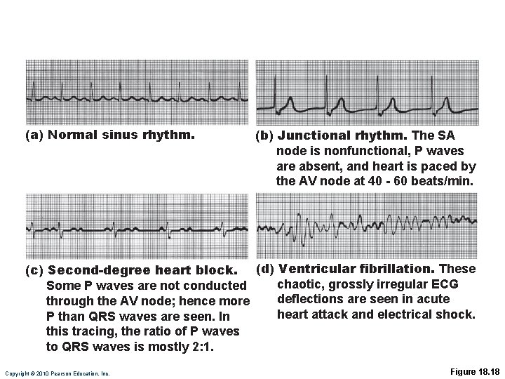(a) Normal sinus rhythm. (b) Junctional rhythm. The SA node is nonfunctional, P waves