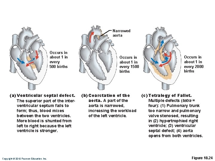 Narrowed aorta Occurs in about 1 in every 500 births (a) Ventricular septal defect.