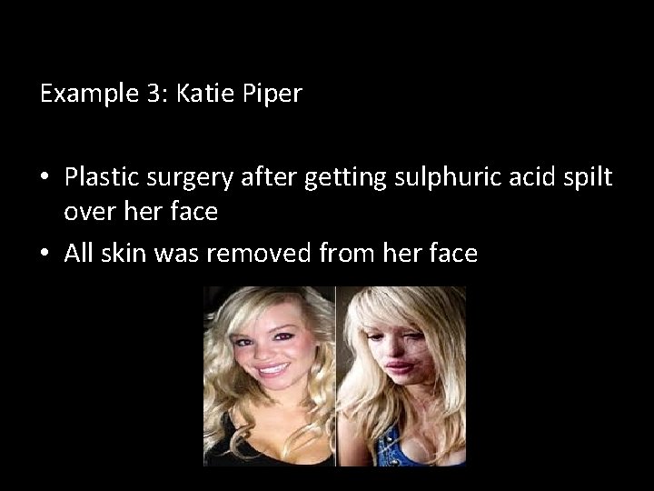 Example 3: Katie Piper • Plastic surgery after getting sulphuric acid spilt over her