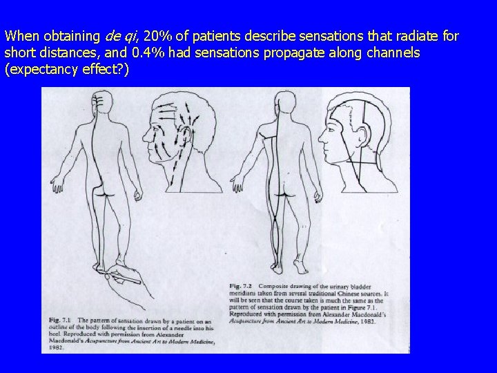 When obtaining de qi, 20% of patients describe sensations that radiate for short distances,