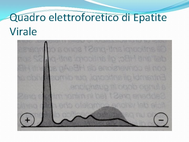 Quadro elettroforetico di Epatite Virale 