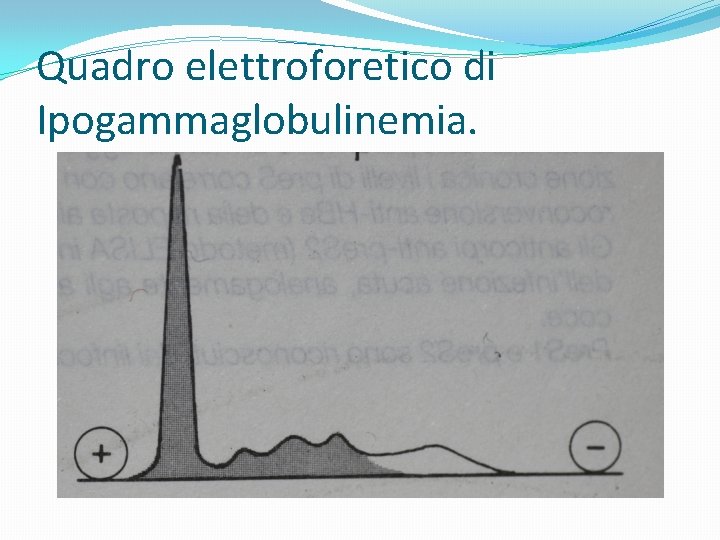 Quadro elettroforetico di Ipogammaglobulinemia. 