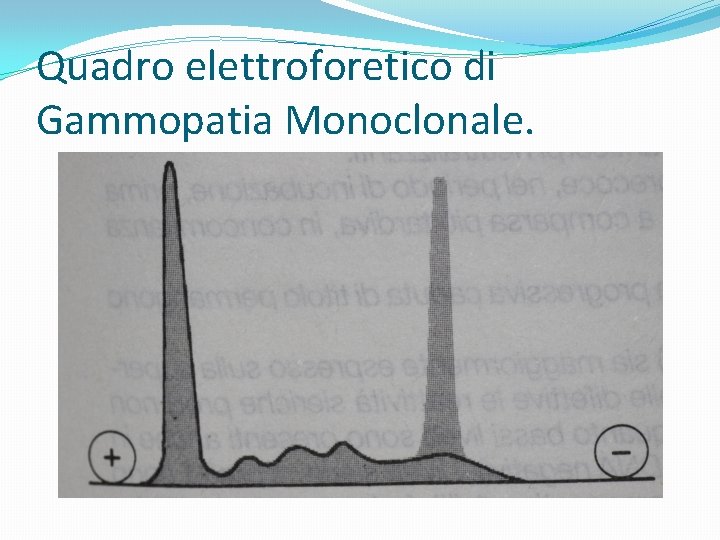 Quadro elettroforetico di Gammopatia Monoclonale. 