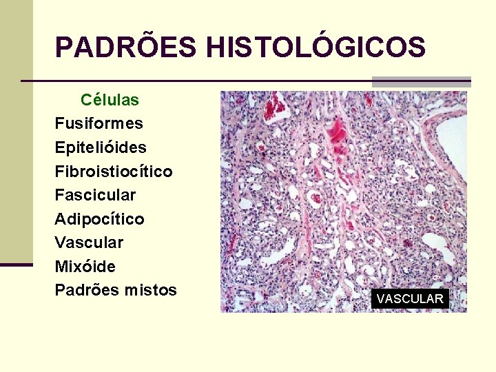 PADRÕES HISTOLÓGICOS Células Fusiformes Epitelióides Fibroistiocítico Fascicular Adipocítico Vascular Mixóide Padrões mistos VASCULAR 