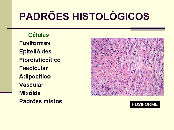 PADRÕES HISTOLÓGICOS Células Fusiformes Epitelióides Fibroistiocítico Fascicular Adipocítico Vascular Mixóide Padrões mistos FUSIFORME 