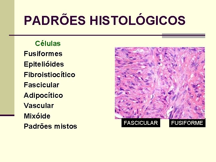 PADRÕES HISTOLÓGICOS Células Fusiformes Epitelióides Fibroistiocítico Fascicular Adipocítico Vascular Mixóide Padrões mistos FASCICULAR FUSIFORME