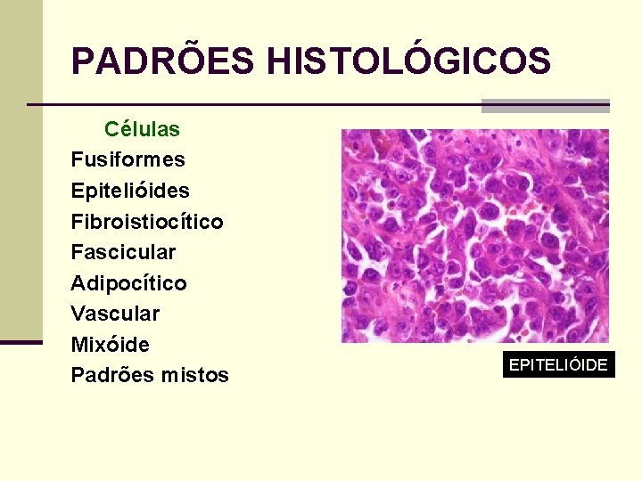 PADRÕES HISTOLÓGICOS Células Fusiformes Epitelióides Fibroistiocítico Fascicular Adipocítico Vascular Mixóide Padrões mistos EPITELIÓIDE 