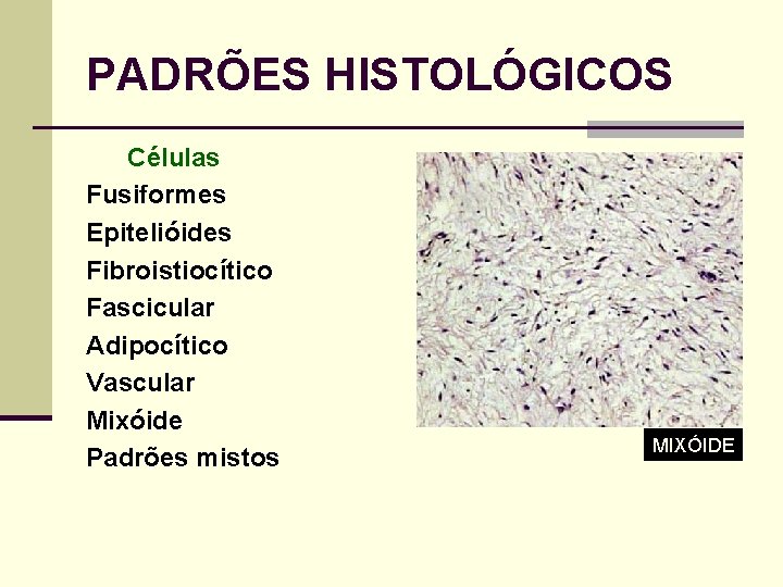 PADRÕES HISTOLÓGICOS Células Fusiformes Epitelióides Fibroistiocítico Fascicular Adipocítico Vascular Mixóide Padrões mistos MIXÓIDE 