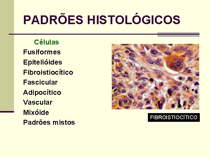 PADRÕES HISTOLÓGICOS Células Fusiformes Epitelióides Fibroistiocítico Fascicular Adipocítico Vascular Mixóide Padrões mistos FIBROISTIOCÍTICO 