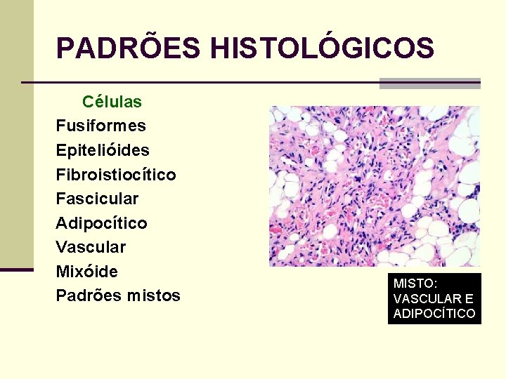 PADRÕES HISTOLÓGICOS Células Fusiformes Epitelióides Fibroistiocítico Fascicular Adipocítico Vascular Mixóide Padrões mistos MISTO: VASCULAR