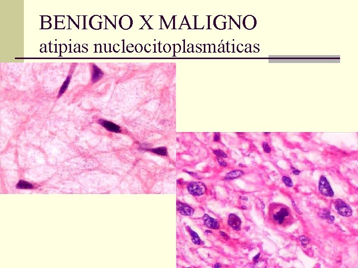 BENIGNO X MALIGNO atipias nucleocitoplasmáticas 
