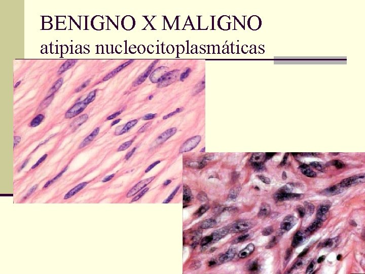 BENIGNO X MALIGNO atipias nucleocitoplasmáticas 