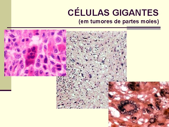 CÉLULAS GIGANTES (em tumores de partes moles) 