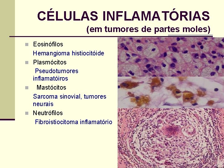 CÉLULAS INFLAMATÓRIAS (em tumores de partes moles) n Eosinófilos Hemangioma histiocitóide n Plasmócitos Pseudotumores