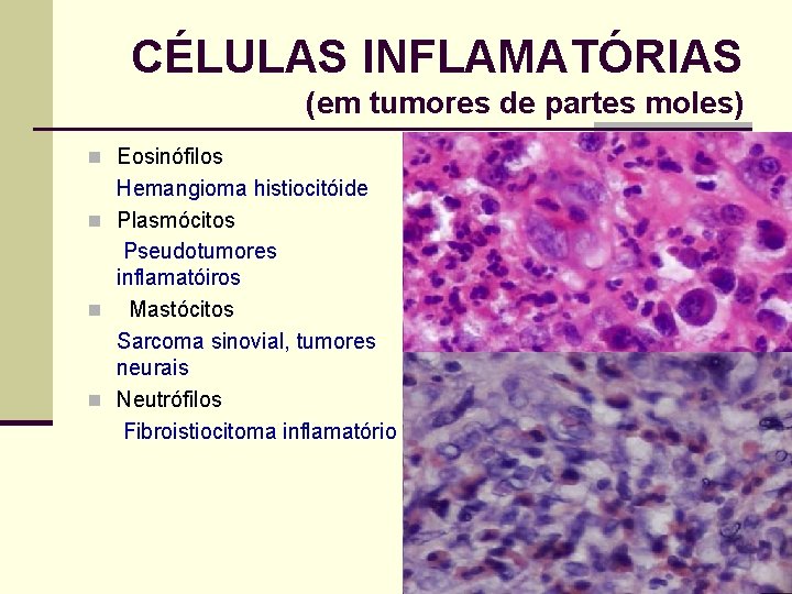 CÉLULAS INFLAMATÓRIAS (em tumores de partes moles) n Eosinófilos Hemangioma histiocitóide n Plasmócitos Pseudotumores