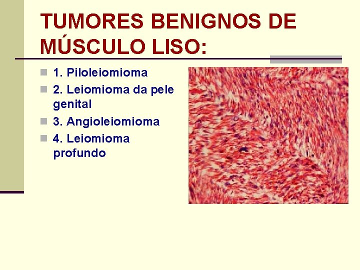 TUMORES BENIGNOS DE MÚSCULO LISO: n 1. Piloleiomioma n 2. Leiomioma da pele genital