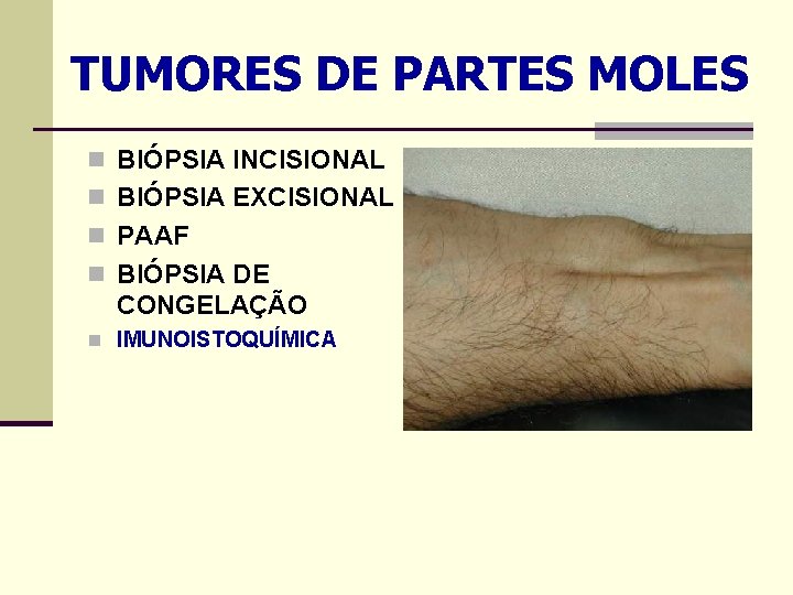 TUMORES DE PARTES MOLES n BIÓPSIA INCISIONAL n BIÓPSIA EXCISIONAL n PAAF n BIÓPSIA