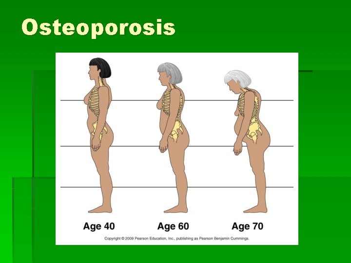 Osteoporosis 