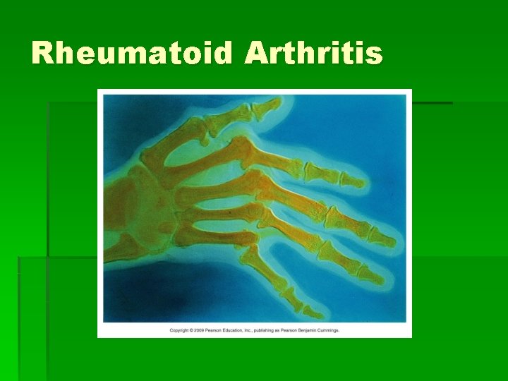 Inflammatory Disorders of Joints Bursitis Sprains Arthritis Bursitis