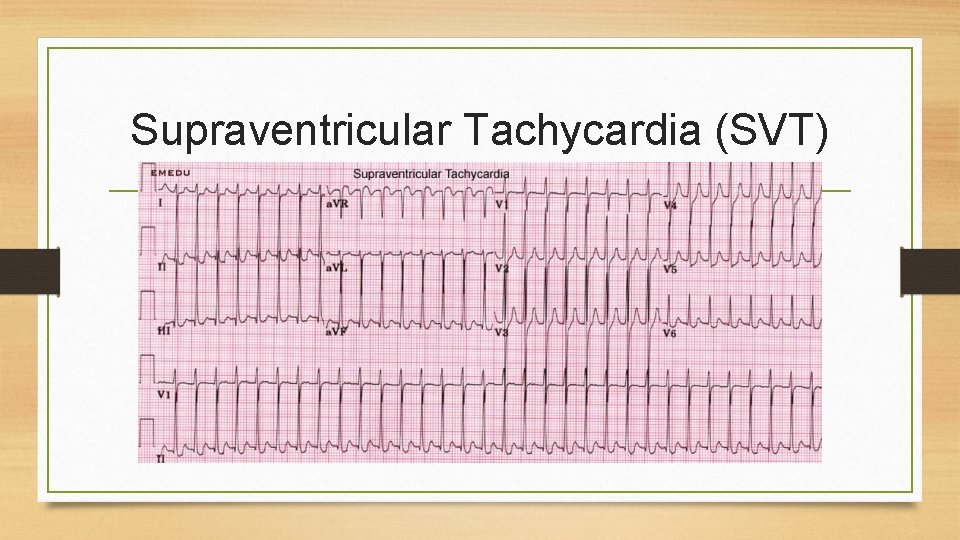 Supraventricular Tachycardia (SVT) 