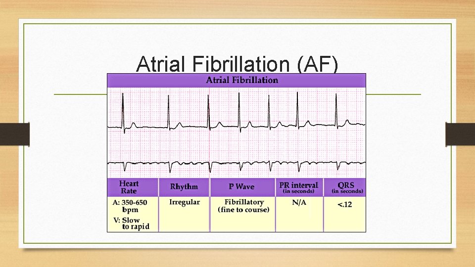 Atrial Fibrillation (AF) 