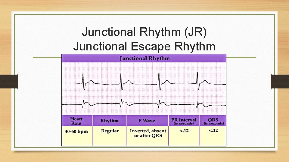 Junctional Rhythm (JR) Junctional Escape Rhythm 