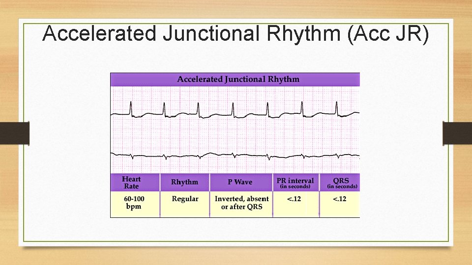 Accelerated Junctional Rhythm (Acc JR) 