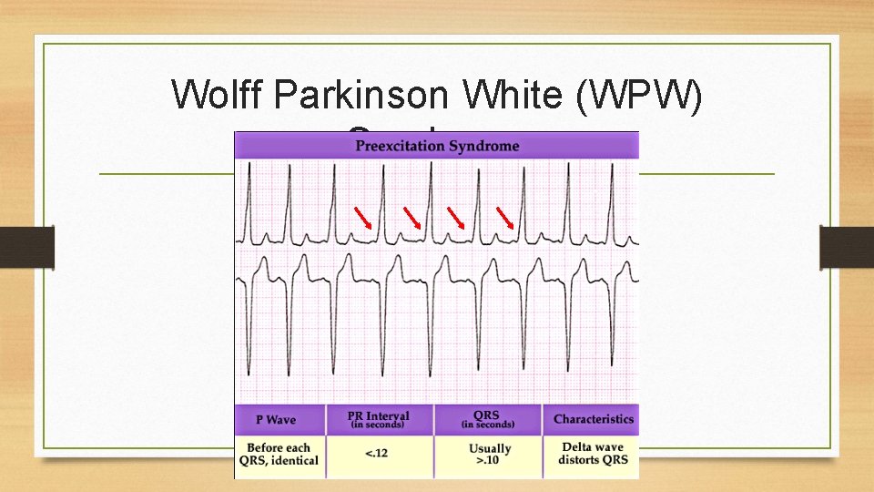 Wolff Parkinson White (WPW) Syndrome 