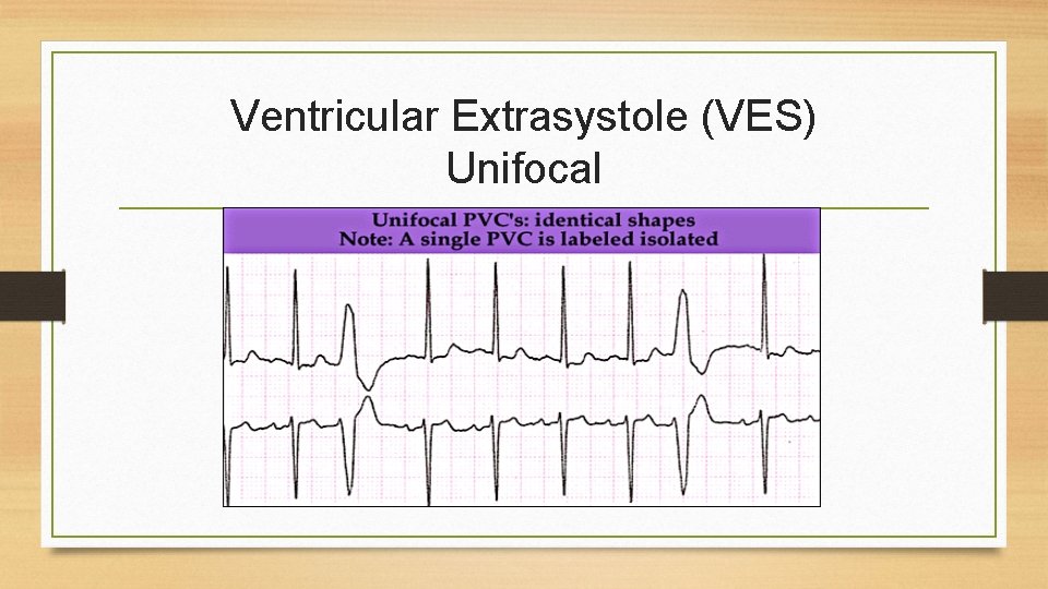 Ventricular Extrasystole (VES) Unifocal 