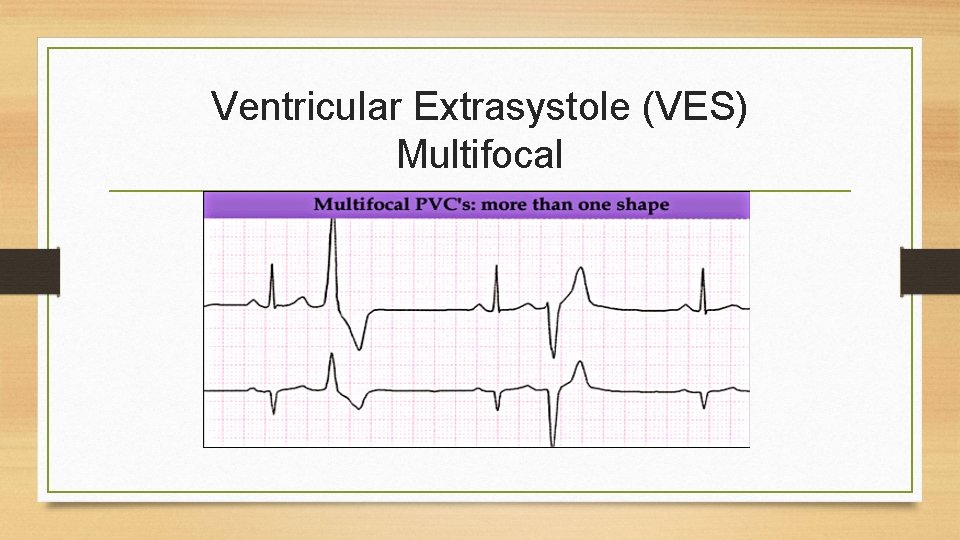 Ventricular Extrasystole (VES) Multifocal 