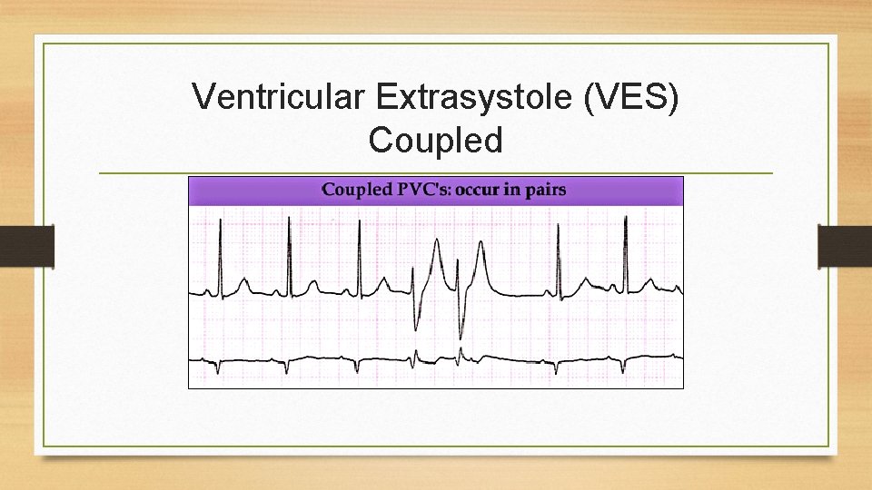 Ventricular Extrasystole (VES) Coupled 