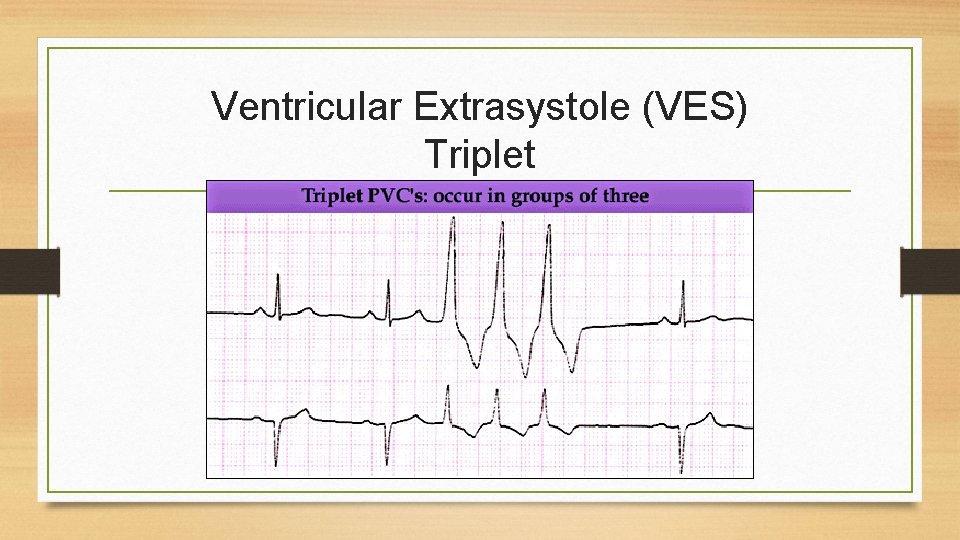 Ventricular Extrasystole (VES) Triplet 