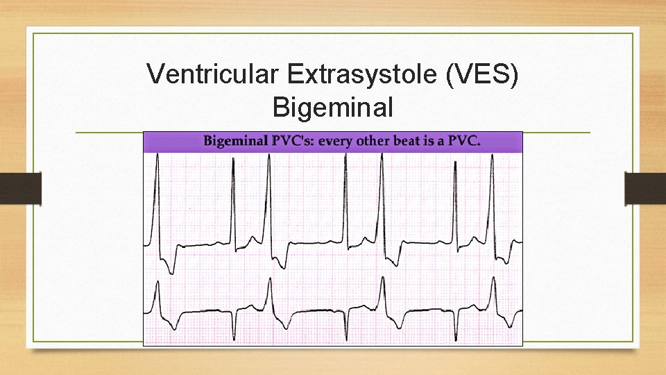 Ventricular Extrasystole (VES) Bigeminal 