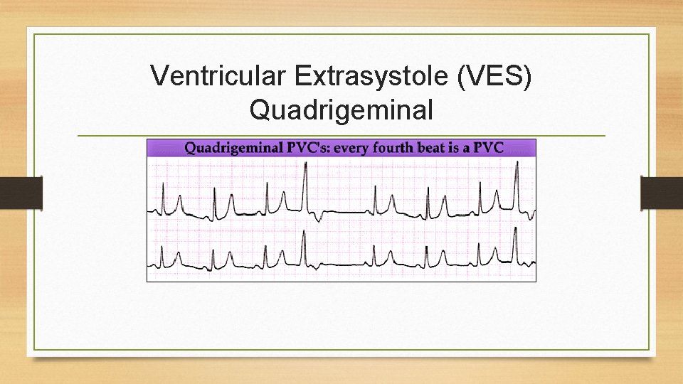 Ventricular Extrasystole (VES) Quadrigeminal 