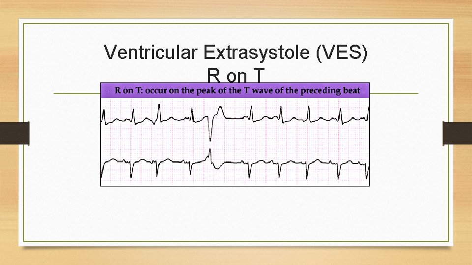 Ventricular Extrasystole (VES) R on T 