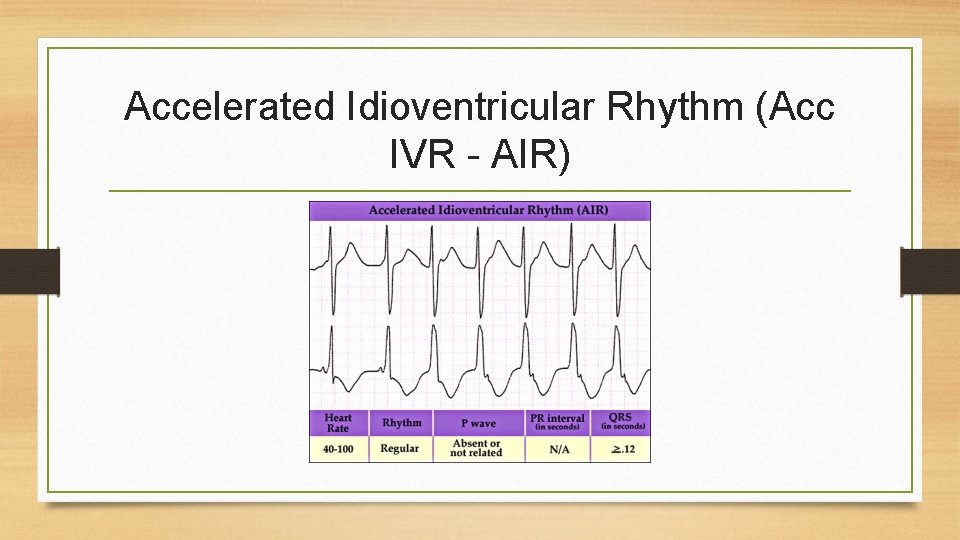 Accelerated Idioventricular Rhythm (Acc IVR - AIR) 