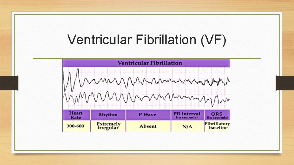 Ventricular Fibrillation (VF) 