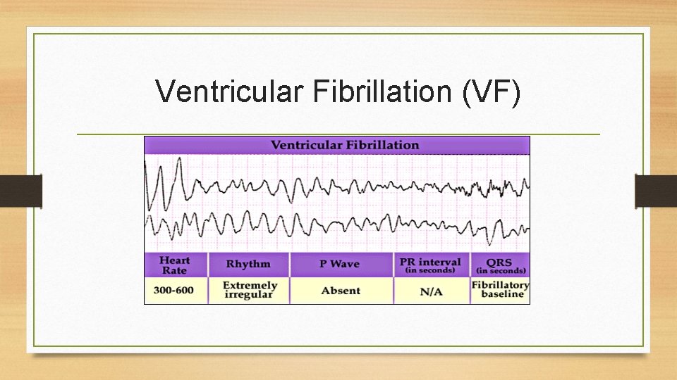 Ventricular Fibrillation (VF) 