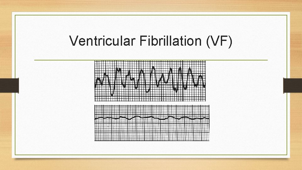 Ventricular Fibrillation (VF) 