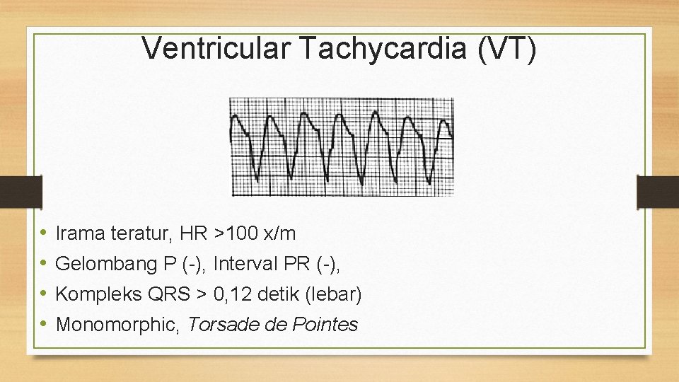 Ventricular Tachycardia (VT) • • Irama teratur, HR >100 x/m Gelombang P (-), Interval