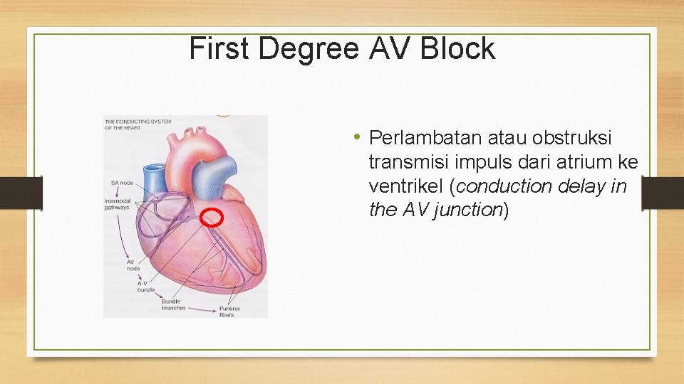 First Degree AV Block • Perlambatan atau obstruksi transmisi impuls dari atrium ke ventrikel