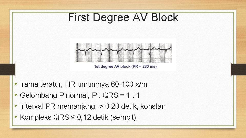 First Degree AV Block • • Irama teratur, HR umumnya 60 -100 x/m Gelombang