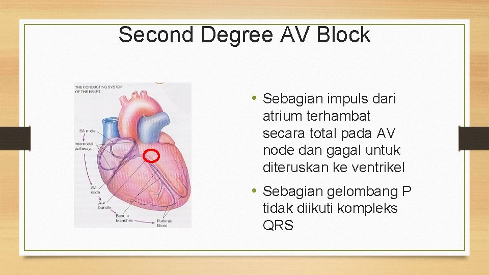 Second Degree AV Block • Sebagian impuls dari atrium terhambat secara total pada AV