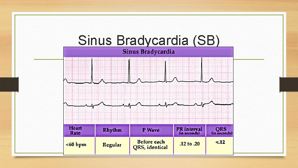 Sinus Bradycardia (SB) 