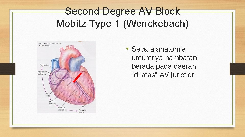 Second Degree AV Block Mobitz Type 1 (Wenckebach) • Secara anatomis umumnya hambatan berada