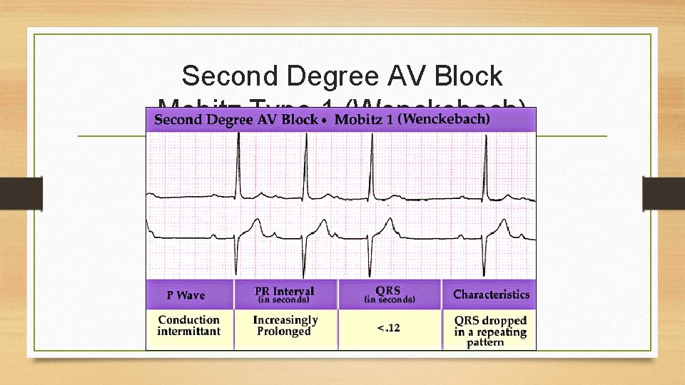 Second Degree AV Block Mobitz Type 1 (Wenckebach) 