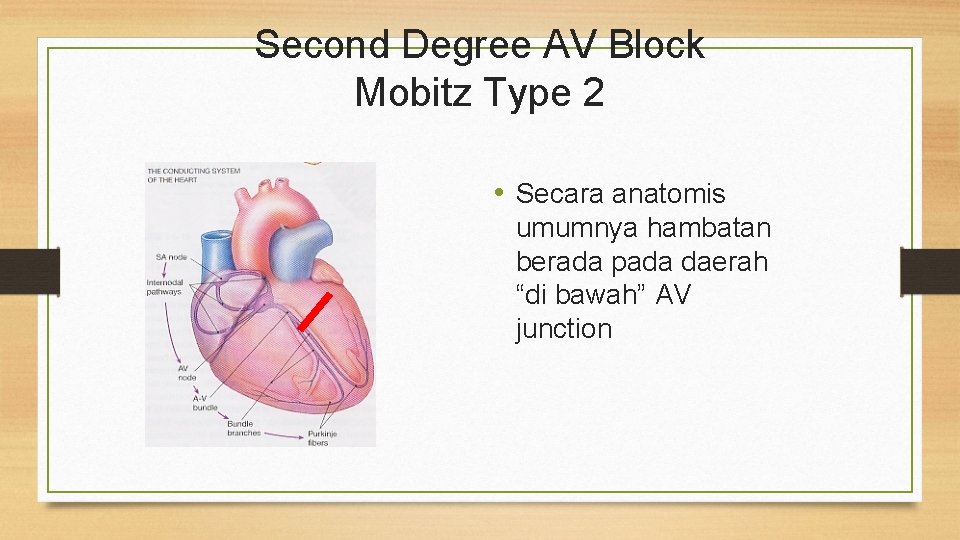 Second Degree AV Block Mobitz Type 2 • Secara anatomis umumnya hambatan berada pada