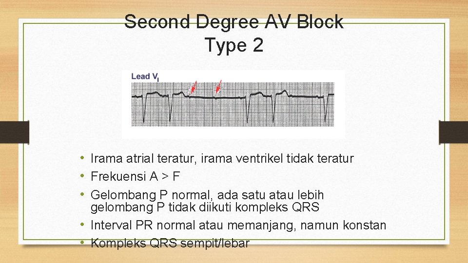 Second Degree AV Block Type 2 • Irama atrial teratur, irama ventrikel tidak teratur